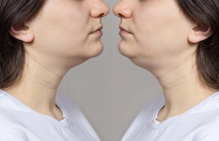 Tratamientos Faciales - Perfilado facial y papada